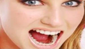 Invisalign Incognito