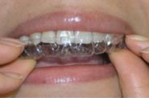 Invisalign