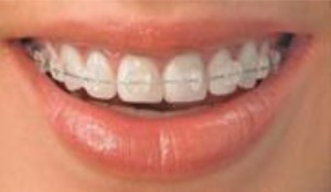 ceramic Clear Braces