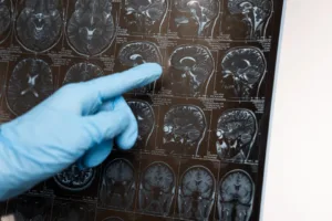 Study links metabolic drugs to improved Alzheimer’s symptoms in mice, highlighting importance of treatment timing